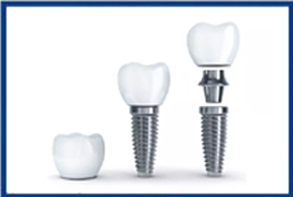 DENTAL IMPLANT CLINIC